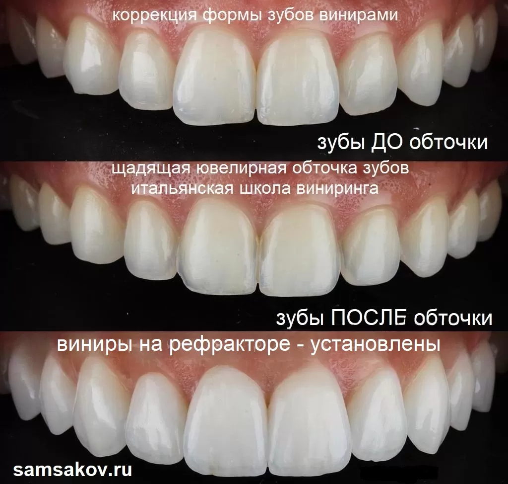Зубы под виниры на рефракторе практически не подвергаются обточке