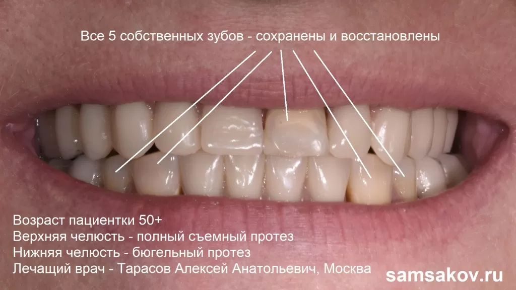 Сохранение собственных зубов при съемном протезировании