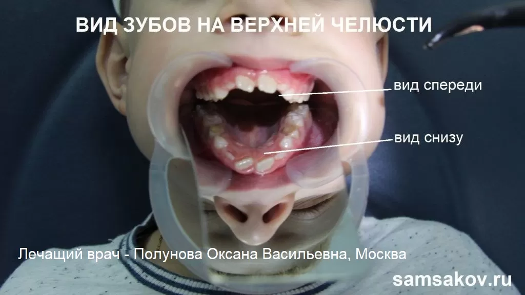 Передние зубы у ребенка - высокий риск травмирования
