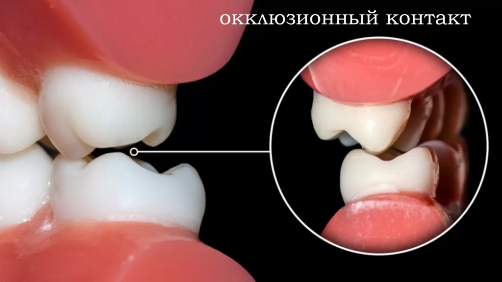 Вид окклюзионного контакта между жевательными зубами-антагонистами на модели