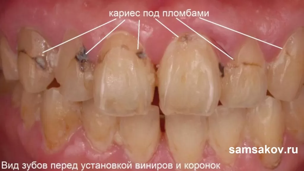 Вид зубов когда много кариеса и кариес эмали