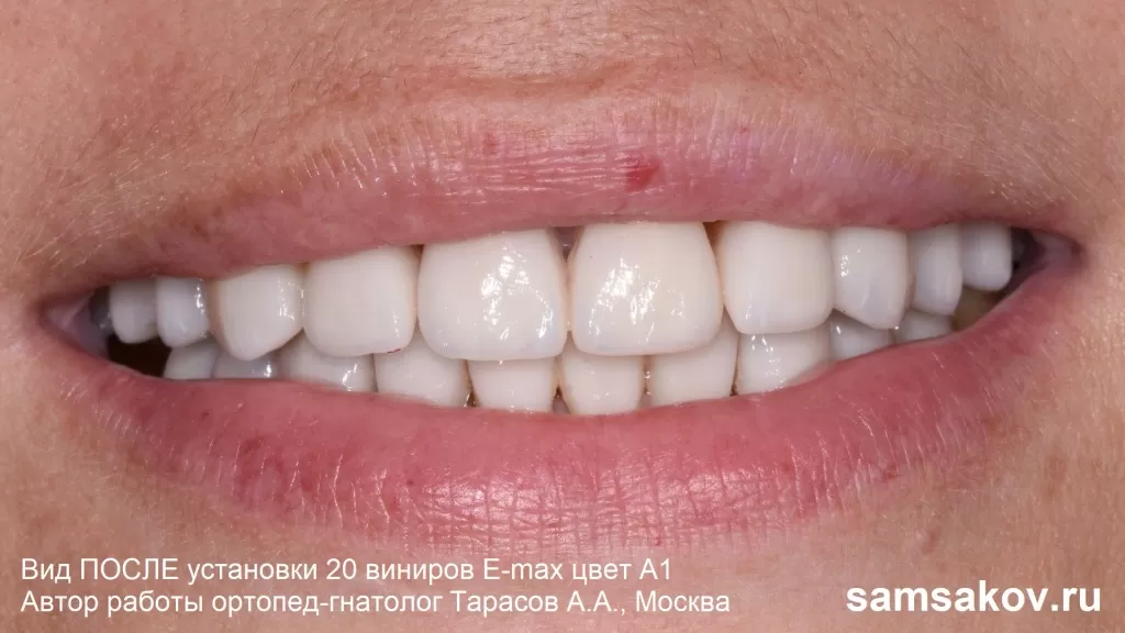 Темные зубы мешали красивой улыбке, пациентка решила поставить виниры – и не прогадала