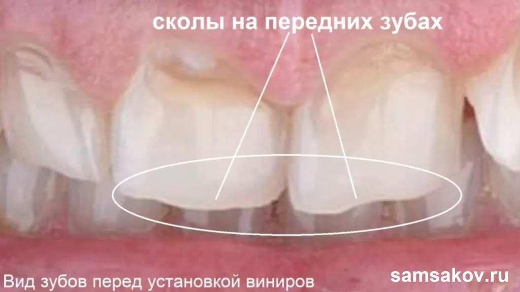 Так выглядели сколы на зубах, полявившиеся в результате двух механических травм