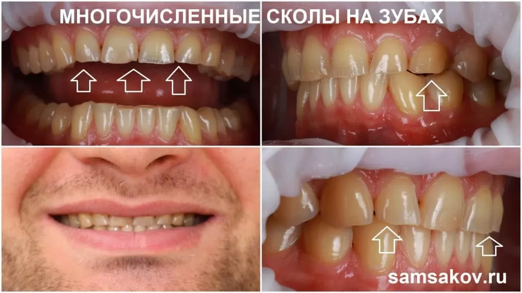 Фото многочисленных сколов на зубах на момент обращения в клинику. Лечащий врач - ортопед Сергей Самсаков