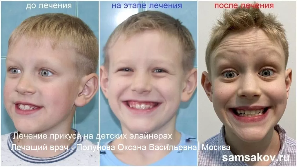 Фото мезиального прикуса ребенка до, во время и после лечения на элайнерах. Врач - Полунова Оксана Васильевна, Москва