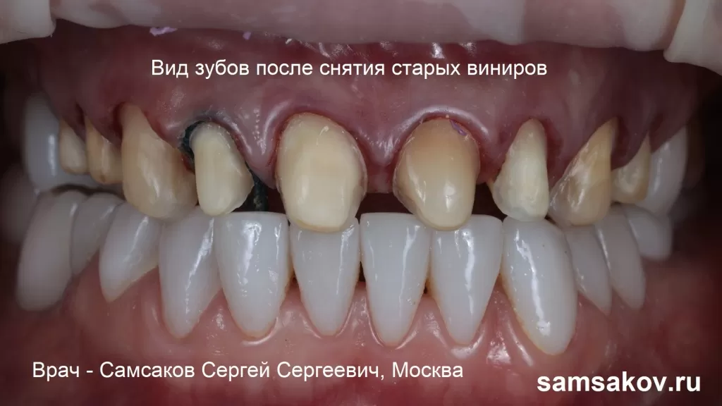 Вид зубов после снятия старых виниров.
