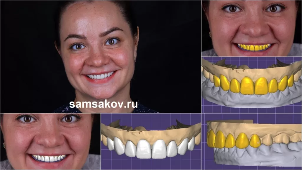 В рамках диагностики сделали 3D проект будущей улыбки на винирах
