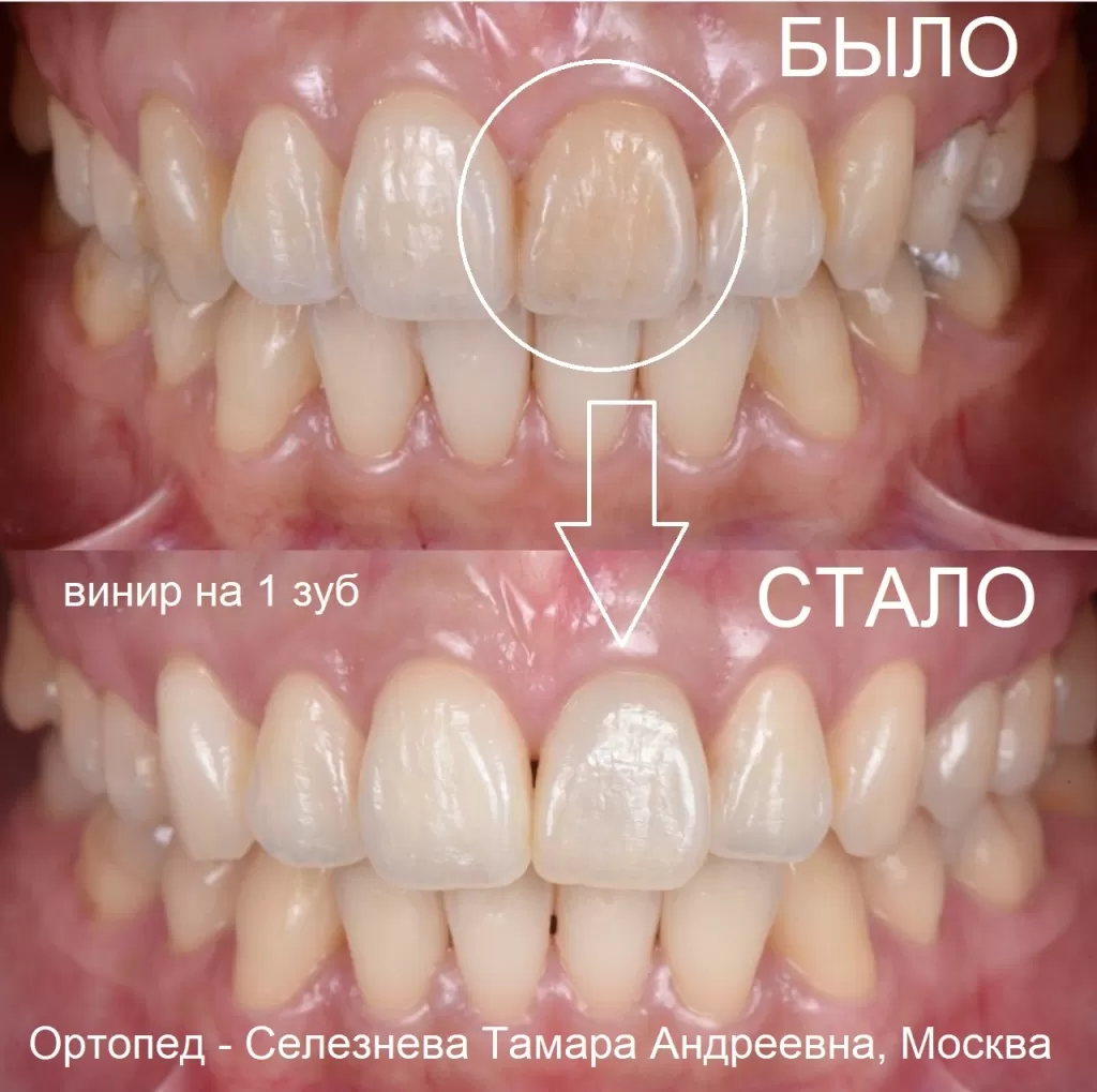 Как всего 1 винир на 1 зуб помог вернуть красивую улыбку пациентке - ортопед Селезнева Тамара, Москва