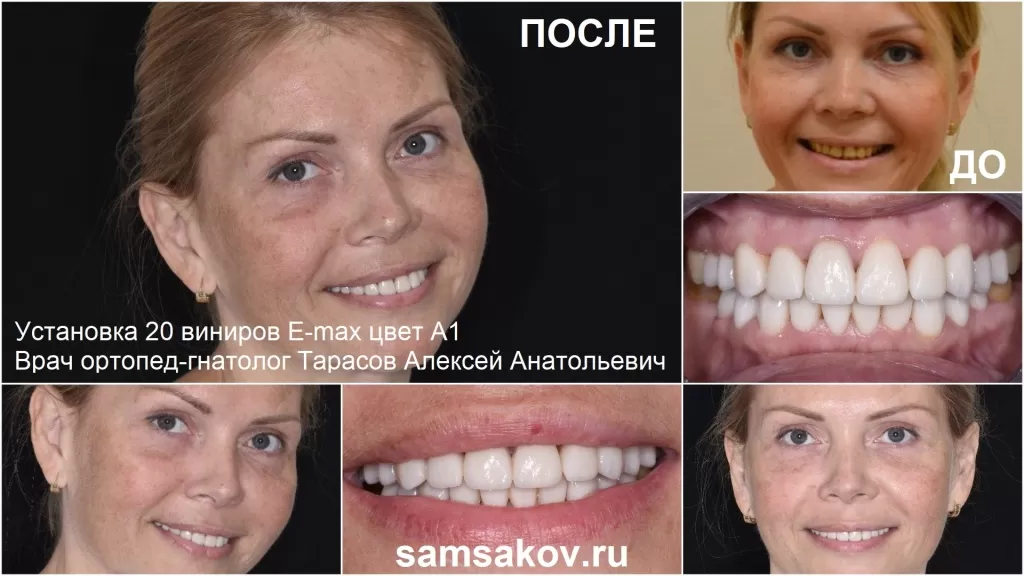 Темные зубы мешали красивой улыбке, пациентка решила поставить виниры Емакс цвет А1 – и не прогадала