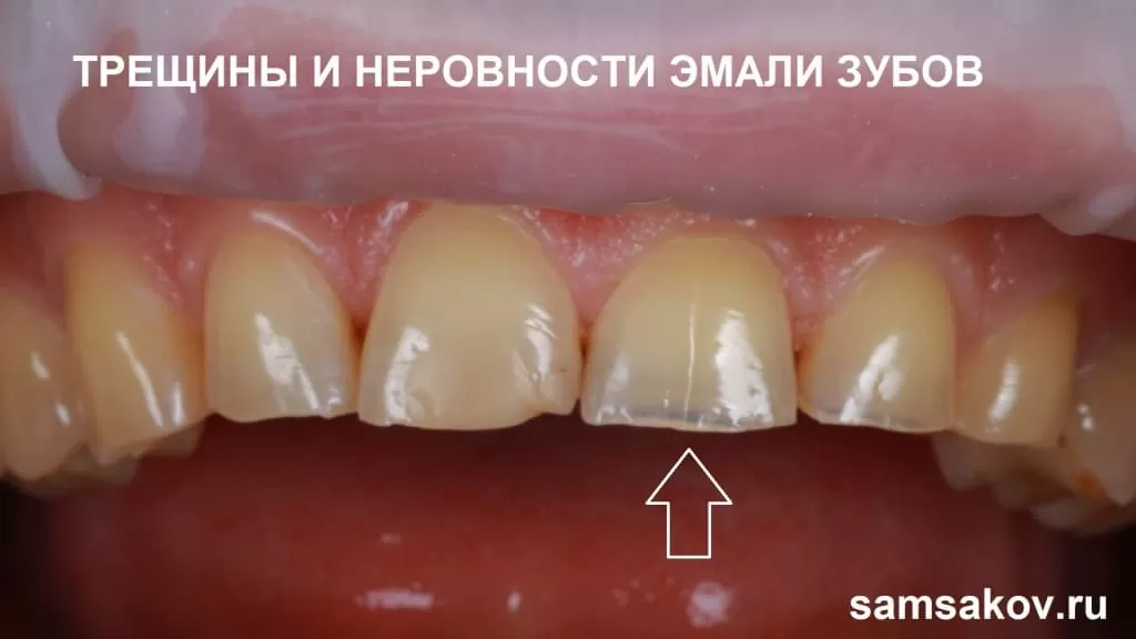 Фото трещин и многочисленных неровностей зубной эмали на момент обращения в клинику. Лечащий стоматолог-ортопед Самсаков Сергей 