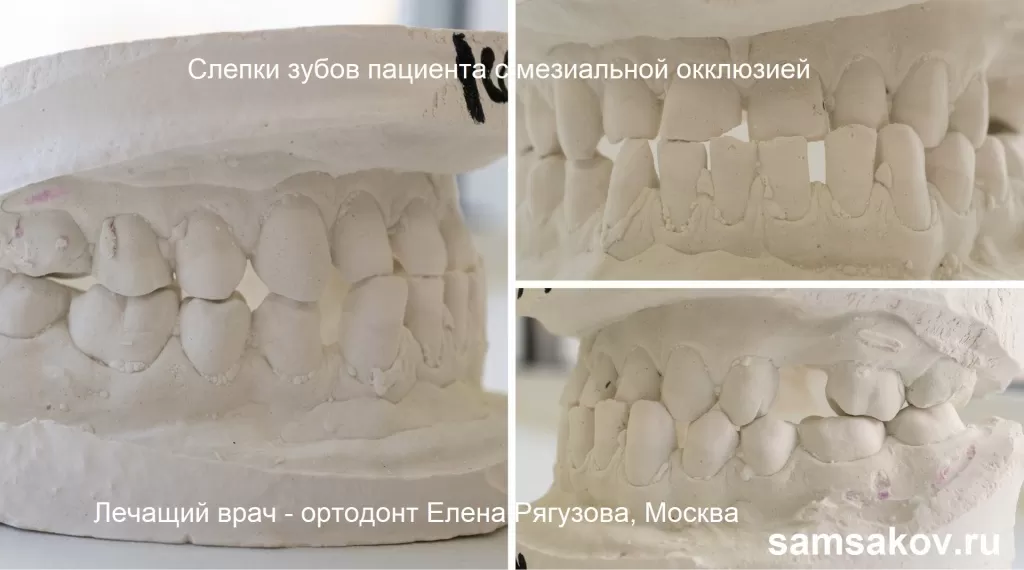 Мезиальный прикус на примере слепков зубов пациенты