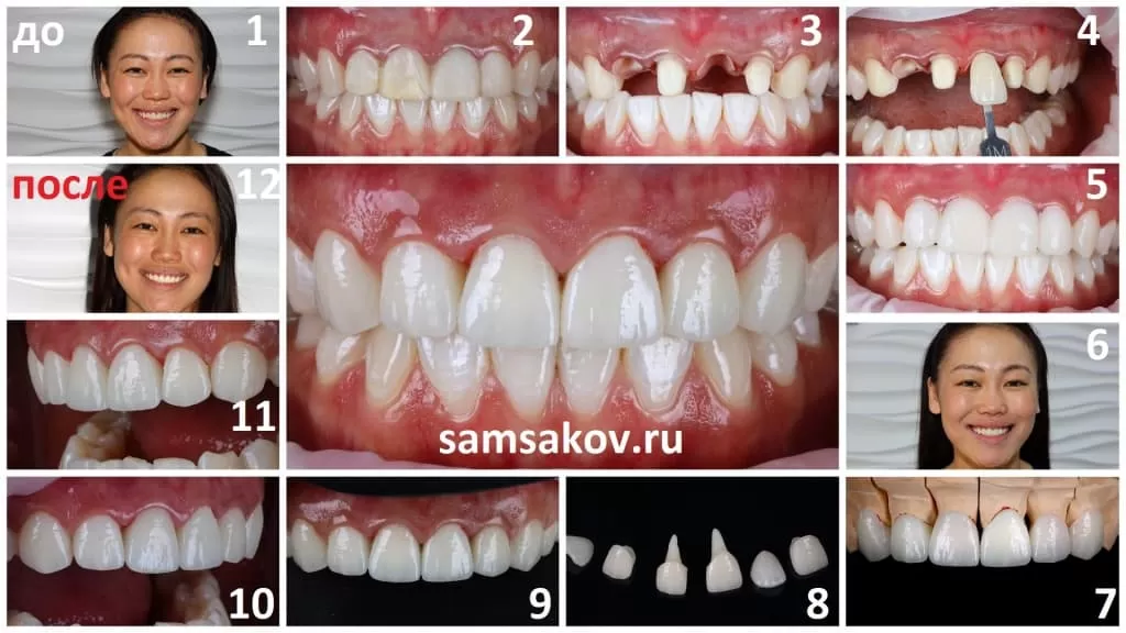 Этапы реставрации зубов