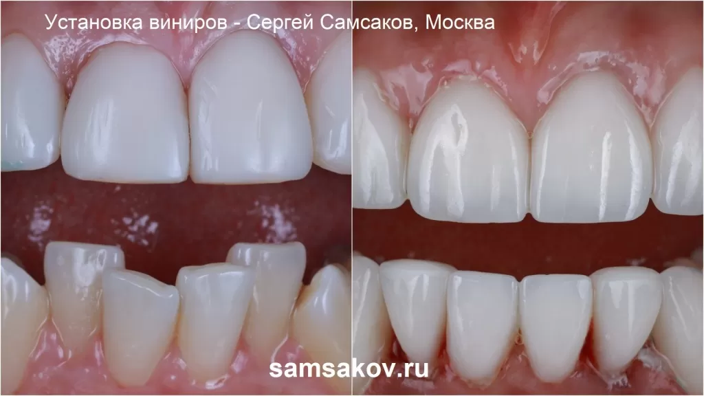 Вид передних зубов после установки виниров. Ортопед Сергей Самсаков, Москва
