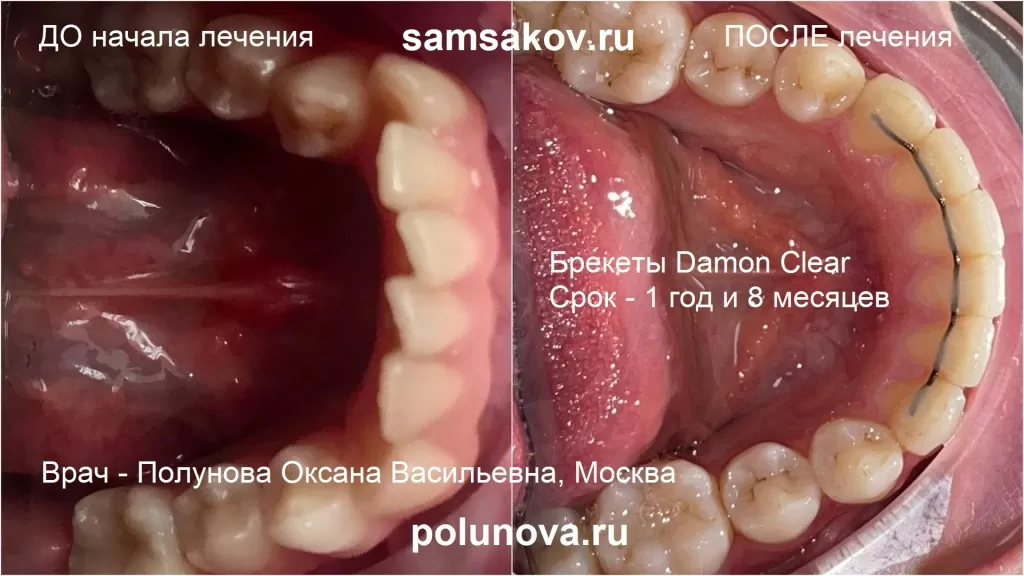Лечение скученности и протрузии зубов на нижней челюсти. Фото до и после. Брекеты Damon Clear.