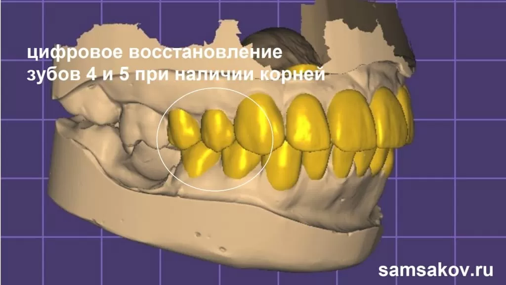 С помощью компьютерных технологий и 3D сканирования сначала мы восстановили виртуальные зубы