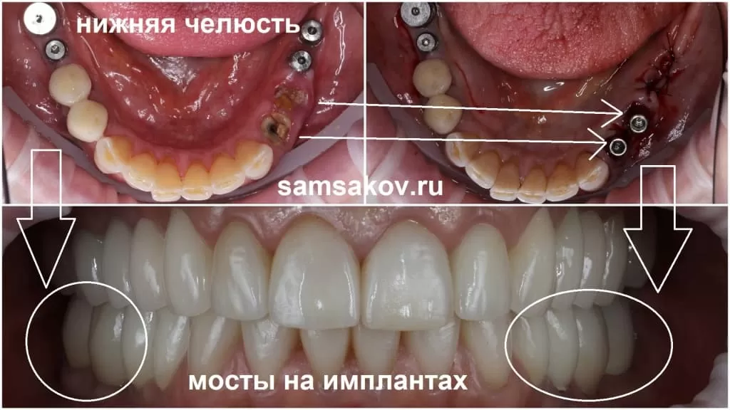 Зубные мосты на имплантах, жевательные зубы