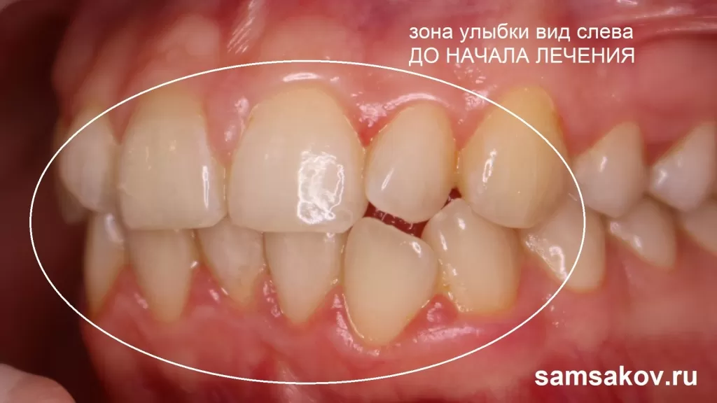 До начала лечения на элайнерах. Вид зубов справа