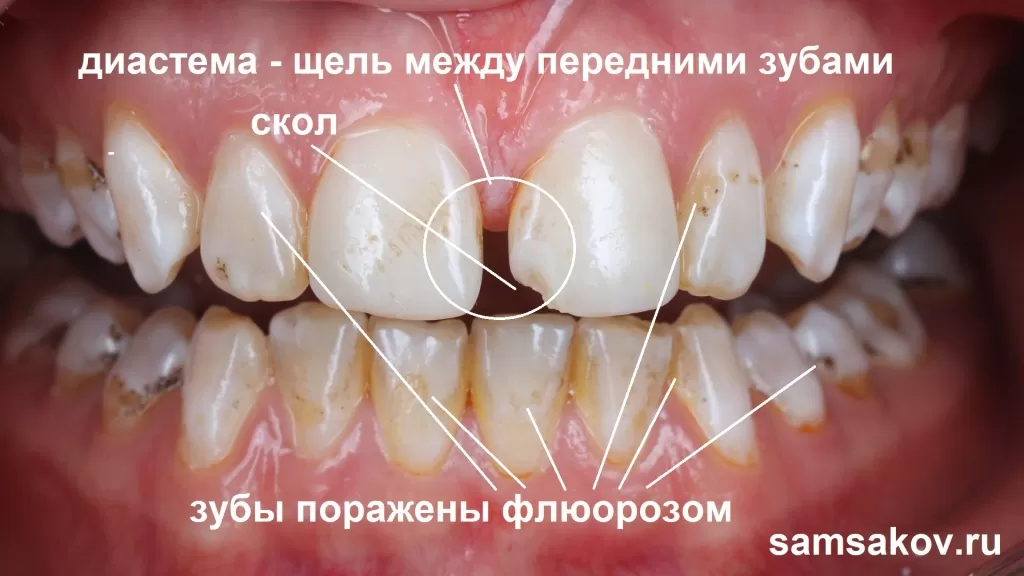 Диастема - щель между передними зубами, флюороз, сколы на зубах