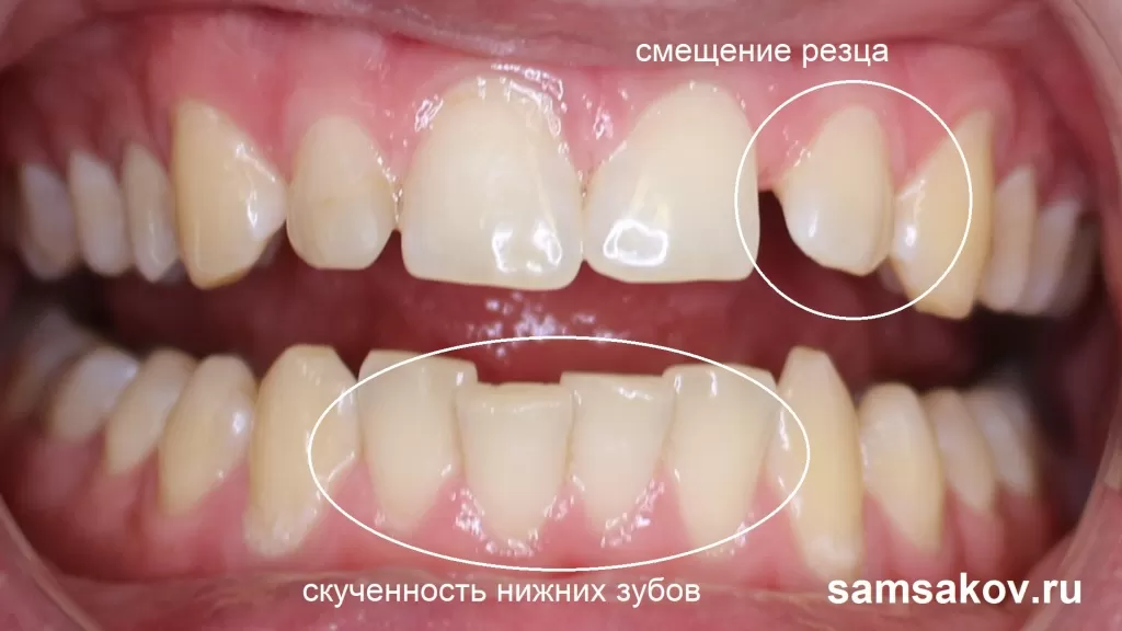 Так выглядели зубы нашего пациента до начала исправления прикуса