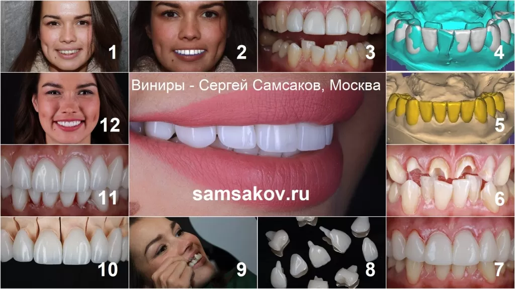Фото этапы установки виниров на кривые зубы. Ортопед Сергей Самсаков, Москва