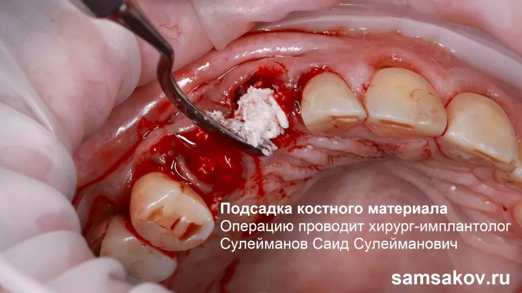 Хирург-имплантолог Сулейманов Саид Сулейманович проводит подсадку костного материала