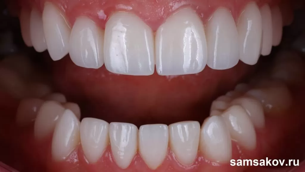 Фото восстановленных зубов и корней зубов