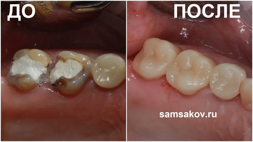 Восстановление жевательных зубов вкладками CEREC
