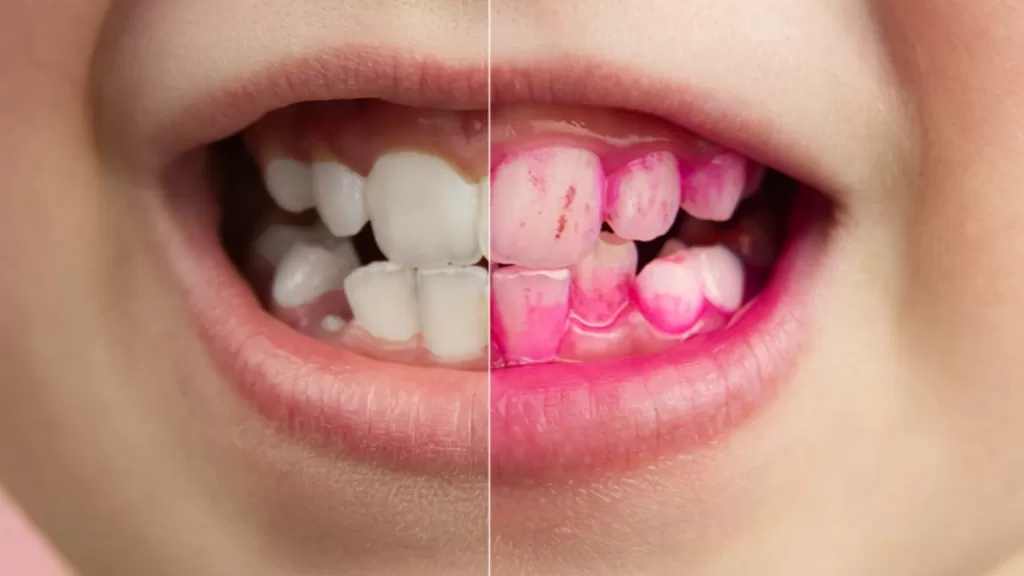Оценка состояния гигиены по индексу гигиены полости рта может проводится как у взрослых, так и у детей