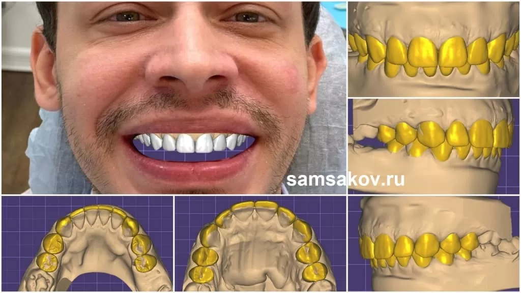 Фото 3д моделирования зубов под виниры