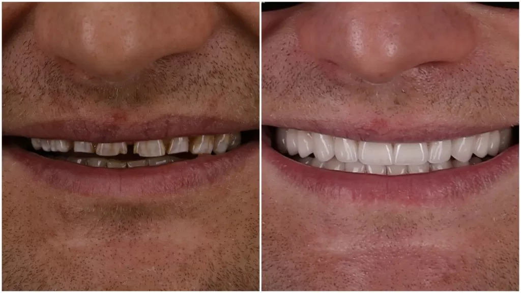 Вот так выглядит улыбка человека при сильной стираемости зубов