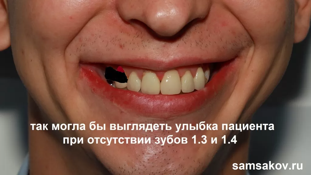 Так условно выглядит зона улыбки при отсутствии двух передних боковых зубов