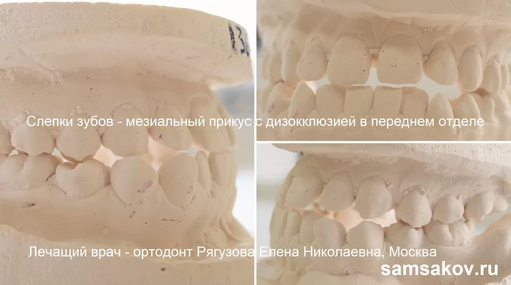 Мезиальный прикус на примере слепков зубов пациента