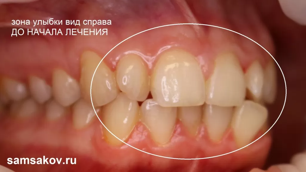Вид зубов справа до начала лечения на капах
