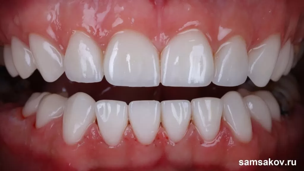 Восстановленные зубы