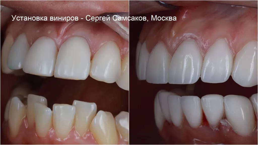 Вид зубов после установки виниров. Фото левой стороны зубных рядов
