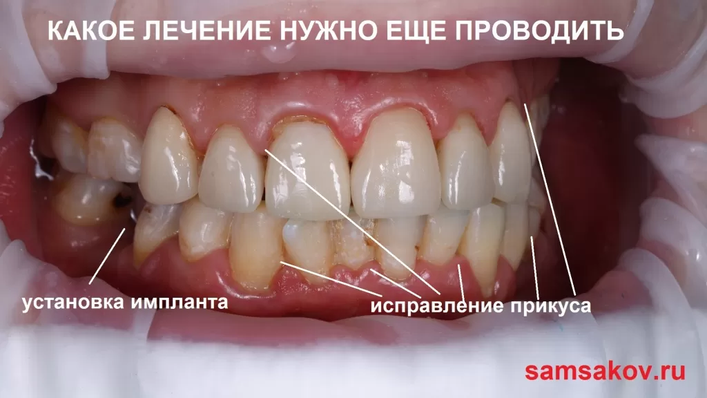Дмитрий необходимы исправление прикуса и имплантация зубов