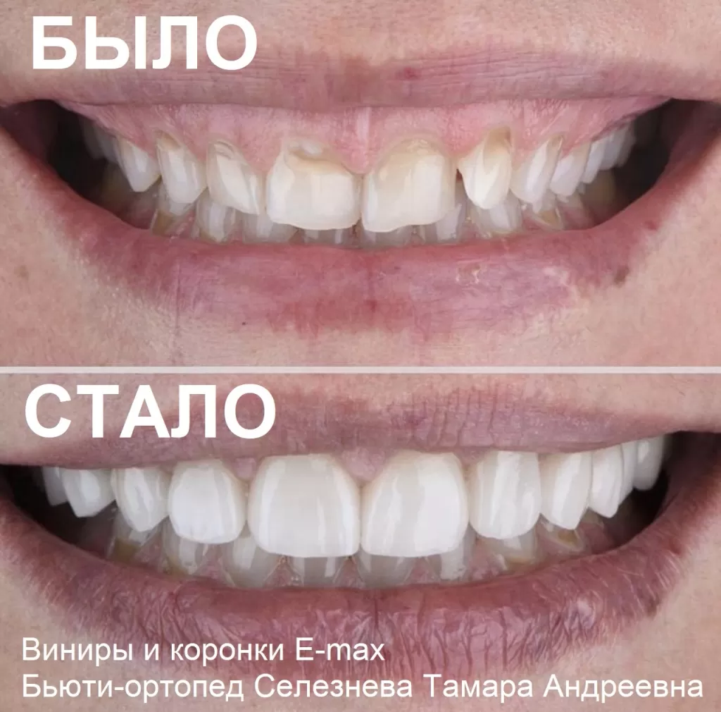 Фото виниры до и после установки при пришеечном кариесе и клиновидном дефекте зубов