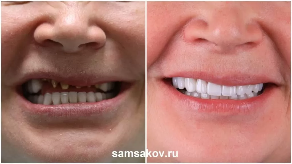 За счет того, что убираем стираемость нижних зубов, люди - меняются. Как меняются? - они, как правило, начинают собой заниматься больше, они видят как они помолодели, как изменилось их лицо