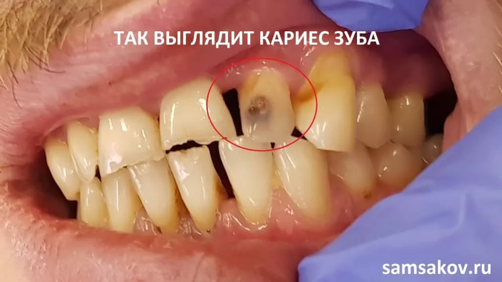 На фото вы видите темное пятно на зубе - это кариес