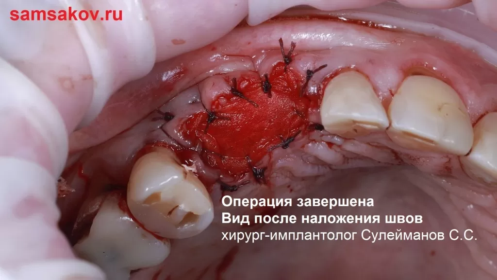 Наложение швов для завершения операции костной пластики. Хирург-имплантолог Сулейманов Саид Сулейманович, Москва