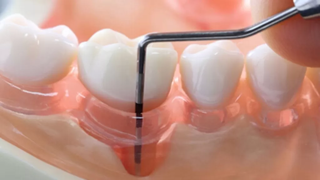 Кюретаж пародонтальных карманов - это хирургическая процедура, выполняемая в стоматологии для очистки и удаления инфицированных тканей из глубоких пародонтальных карманов, образовавшихся в результате пародонтита