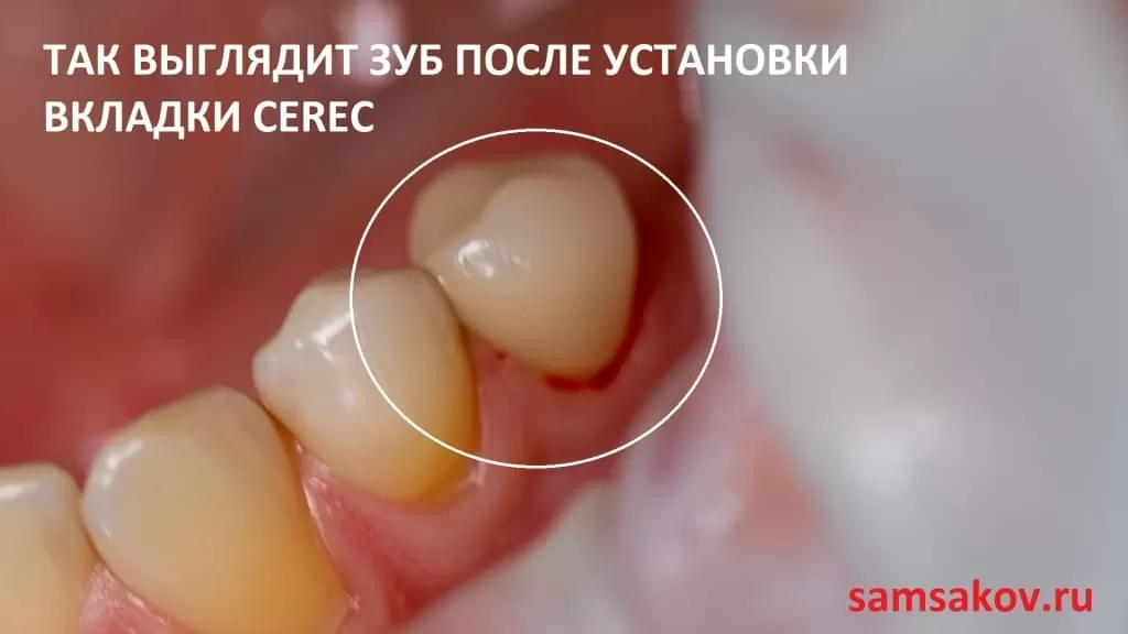 керамическая вкладка на зуб cerec