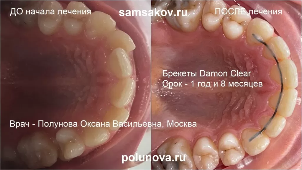 Лечение протрузии и скученности зубов на верхней челюсти. Фото до и после. Брекеты Damon Clear