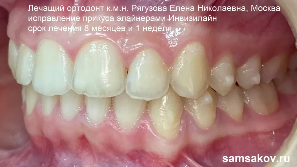 Фото правильных контактов зубов после лечения на элайнерах Инвизилайн. Работа ортодонта к.м.н. Рягузовой Елены Николаевны, Москва 