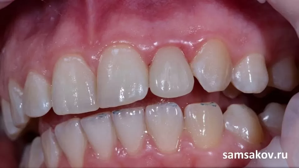 восстановление переднего зуба