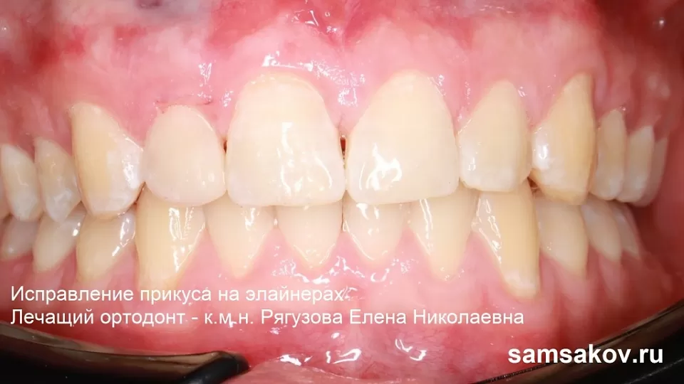 Скученность нижних зубов стала причиной частого кариеса в 32 года
