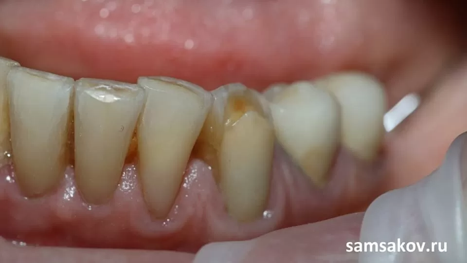 Зуб под пломбой и корень нижнего клыка поражены кариесом. Внутри анкерный штифт.