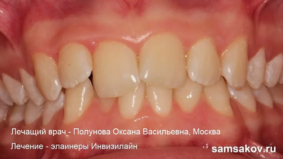 Когда скученность зубов лучше исправляют элайнеры, а не брекеты - ортодонт Полунова Оксана Васильевна, Москва