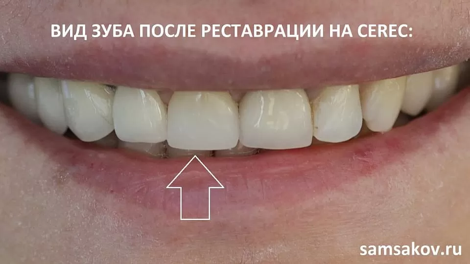 вид зуба после реставрации cerec