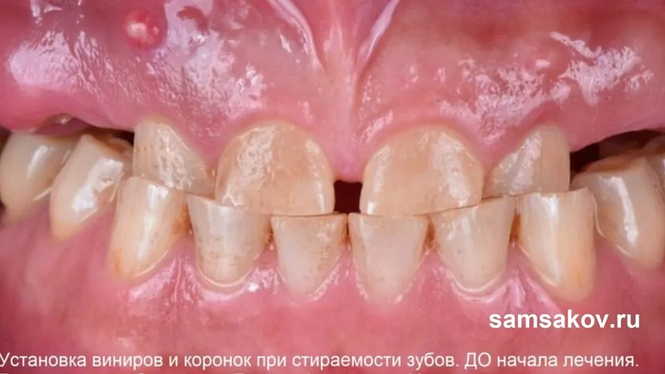 Как быстро остановить стираемость зубов. Бьюти ортопед Самсаков Сергей Сергеевич, Москва